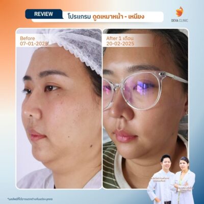 ส่องภาพ Before & After รีวิวดูดไขมันเหนียง 11