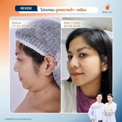 รีวิวภาพก่อน-หลัง ลดเหนียง 8