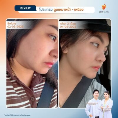 ผลลัพธ์หลังทำ ลดคางสองชั้นจากเคสจริง 8