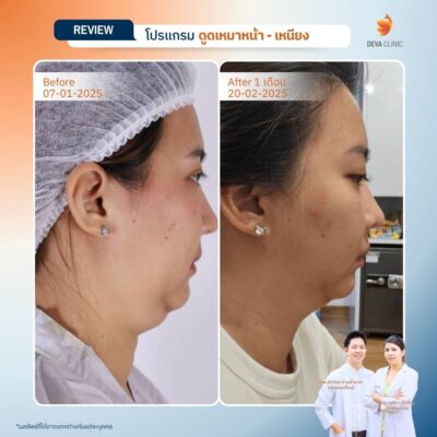 ส่องภาพ Before & After รีวิวดูดไขมันเหนียง 17