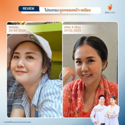 ผลลัพธ์หลังทำ 3 เดือน รีวิวดูดไขมันเหนียง คุณกล้วยไม้ 1