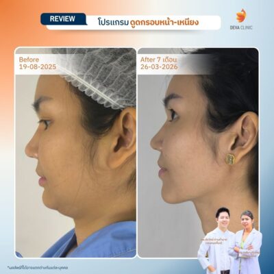 ผลลัพธ์หลังทำ ดูดหน้า เหนียง 20