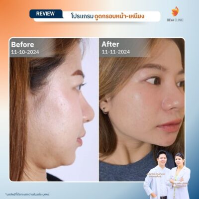 ผลลัพธ์หลังทำ ลดคางสองชั้นจากเคสจริง 32