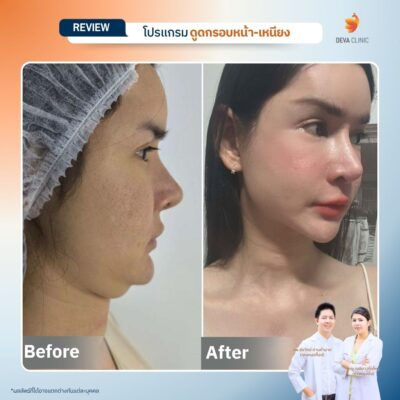 ผลลัพธ์หลังดูดเหนียง