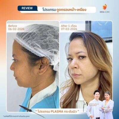 รีวิวภาพก่อน-หลัง ลดเหนียง 12