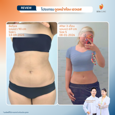 รีวิวดูดไขมันคนผอม หน้าท้อง 4