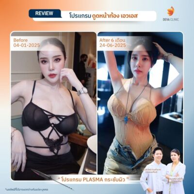 รีวิวก่อนหลังปั้นหุ่น S Curve 5