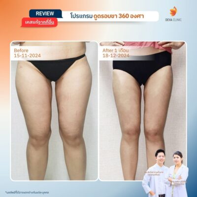 รีวิวเคสแก้ ที่จ่ายแพงกว่าทำครั้งแรก 13