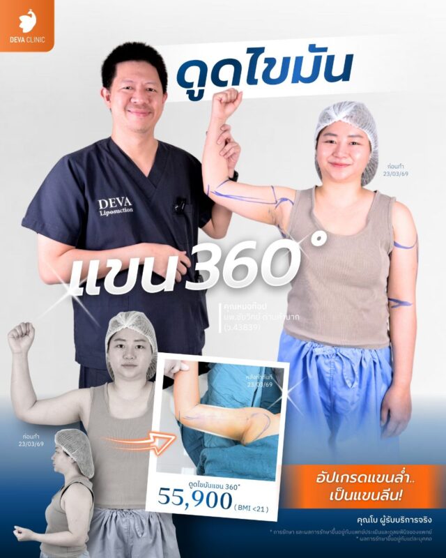 ดูดไขมันที่ไหนดี? เช็คราคาดูดแขน