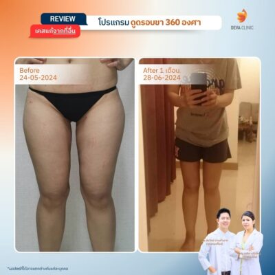 รีวิวเคสแก้ ที่จ่ายแพงกว่าทำครั้งแรก 18
