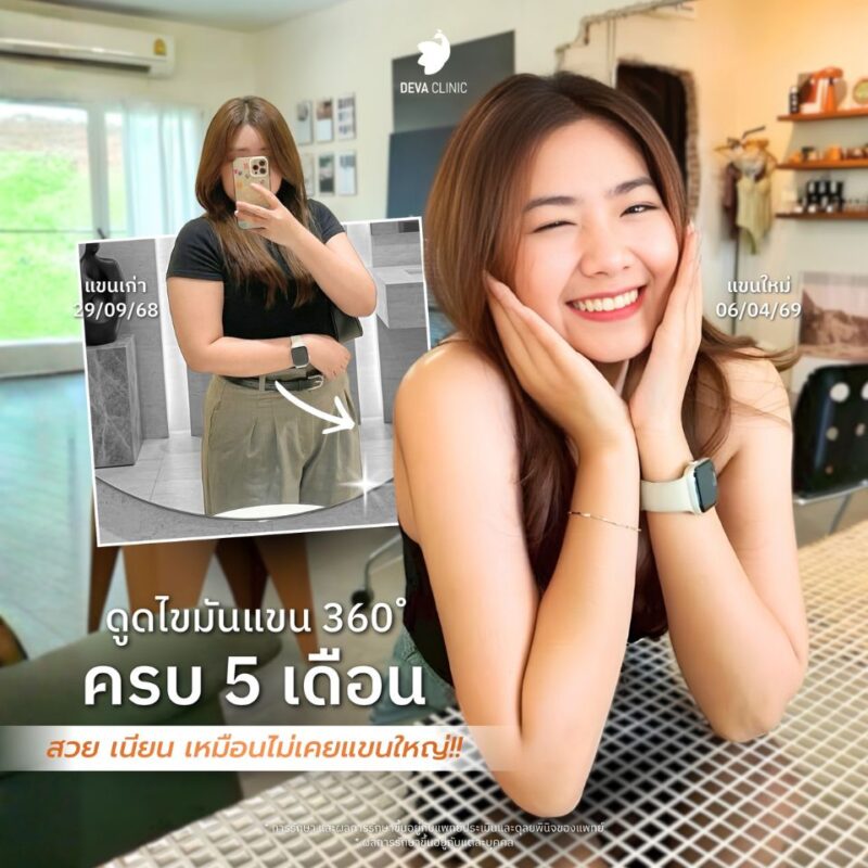 4 สิ่งที่จะได้รับเมื่อ “ดูดไขมันต้นแขน” การรับประกันผลลัพธ์