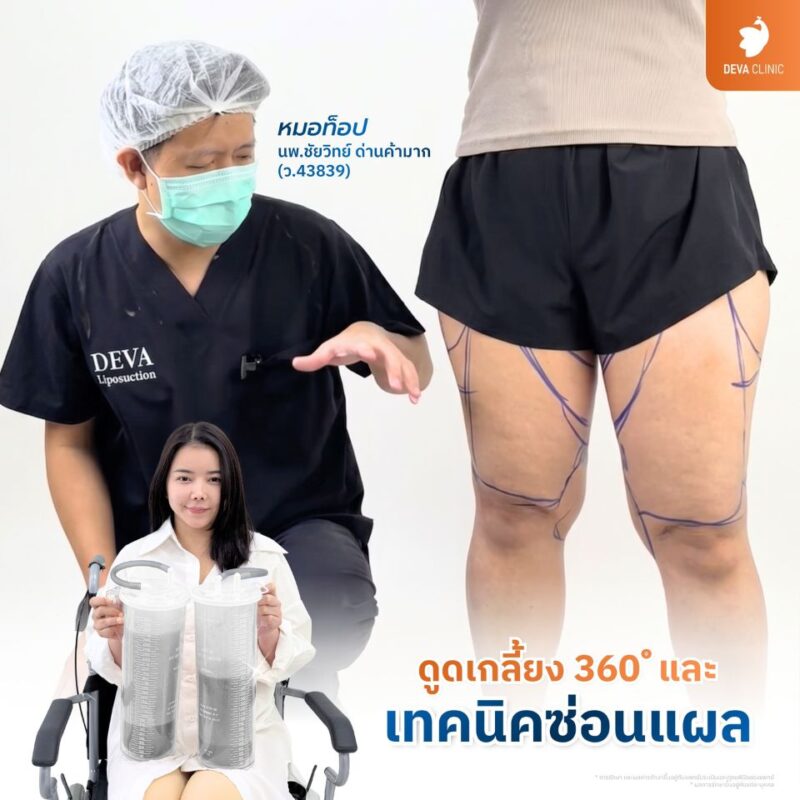 ดูดไขมันต้นขา เทคนิคซ่อนแผลเนียน ไม่ทิ้งรอยแผลเป็นกวนใจ