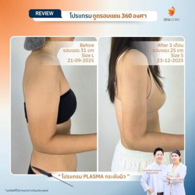 Review ดูดไขมันต้นแขน + J plasma