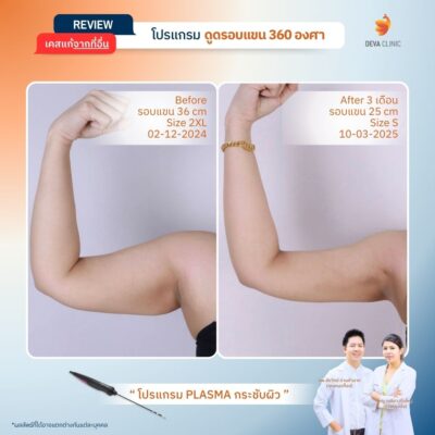 รีวิวเคสก่อน-หลัง J Plasma 12