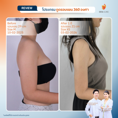 Before & After ต้นแขน 22