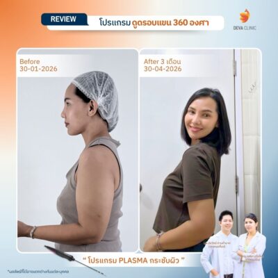 Before & After ต้นแขน 20