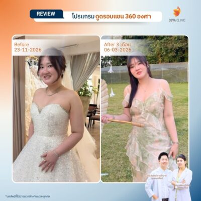 Before & After ต้นแขน 18