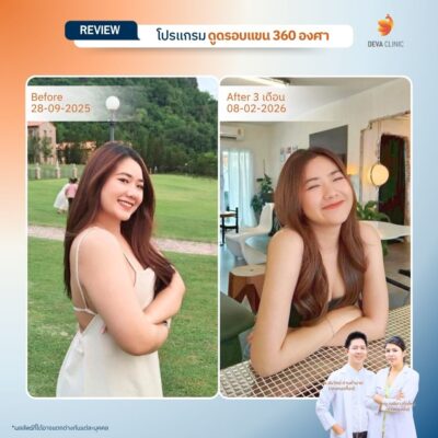 Before & After ต้นแขน 17