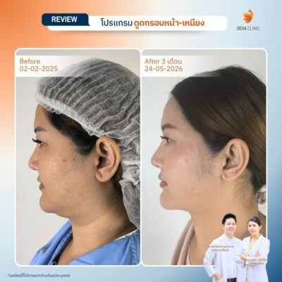 รีวิวดูดหน้าเหนียง คุณมิ้ง 2