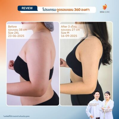 Before & After ต้นแขน 24