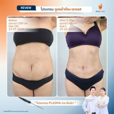 Before & After เจ พลาสมา 21