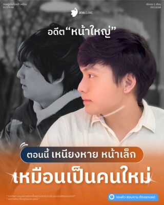 รวมภาพ Before & After: พิสูจน์ผลลัพธ์หน้าเรียว ถาวร จากคนไข้จริง 4