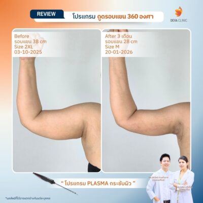 Before & After เจ พลาสมา 25