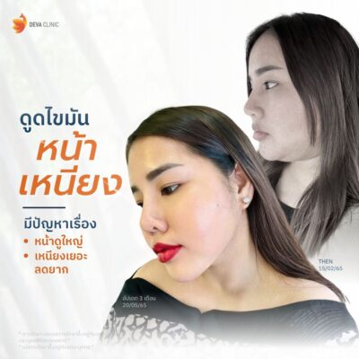 รีวิวจากคนไข้จริง ดูดไขมันเหนียง 1