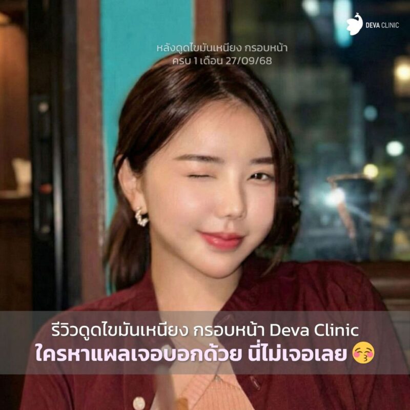 ขนาดแผลดูดไขมันเหนียงใหญ่แค่ไหน? (Micro-Lipo Technique)