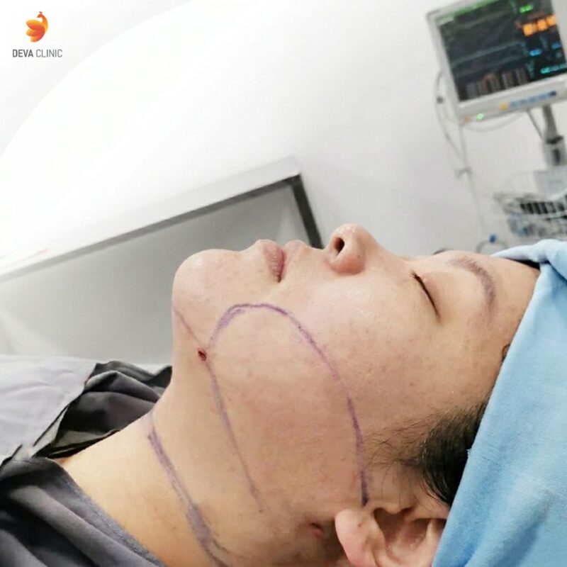 ตำแหน่งแผลดูดเหนียง Deva Clinic