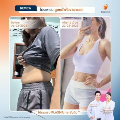 รีวิวเคสก่อน-หลัง J Plasma 1