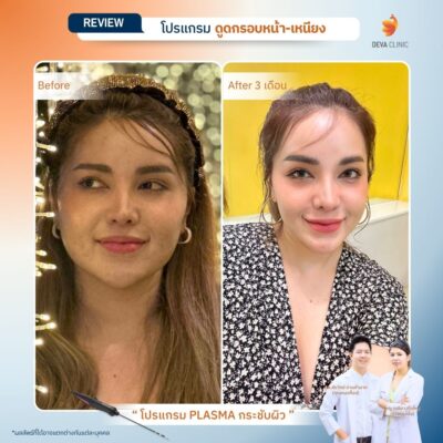 Before & After เจ พลาสมา 3