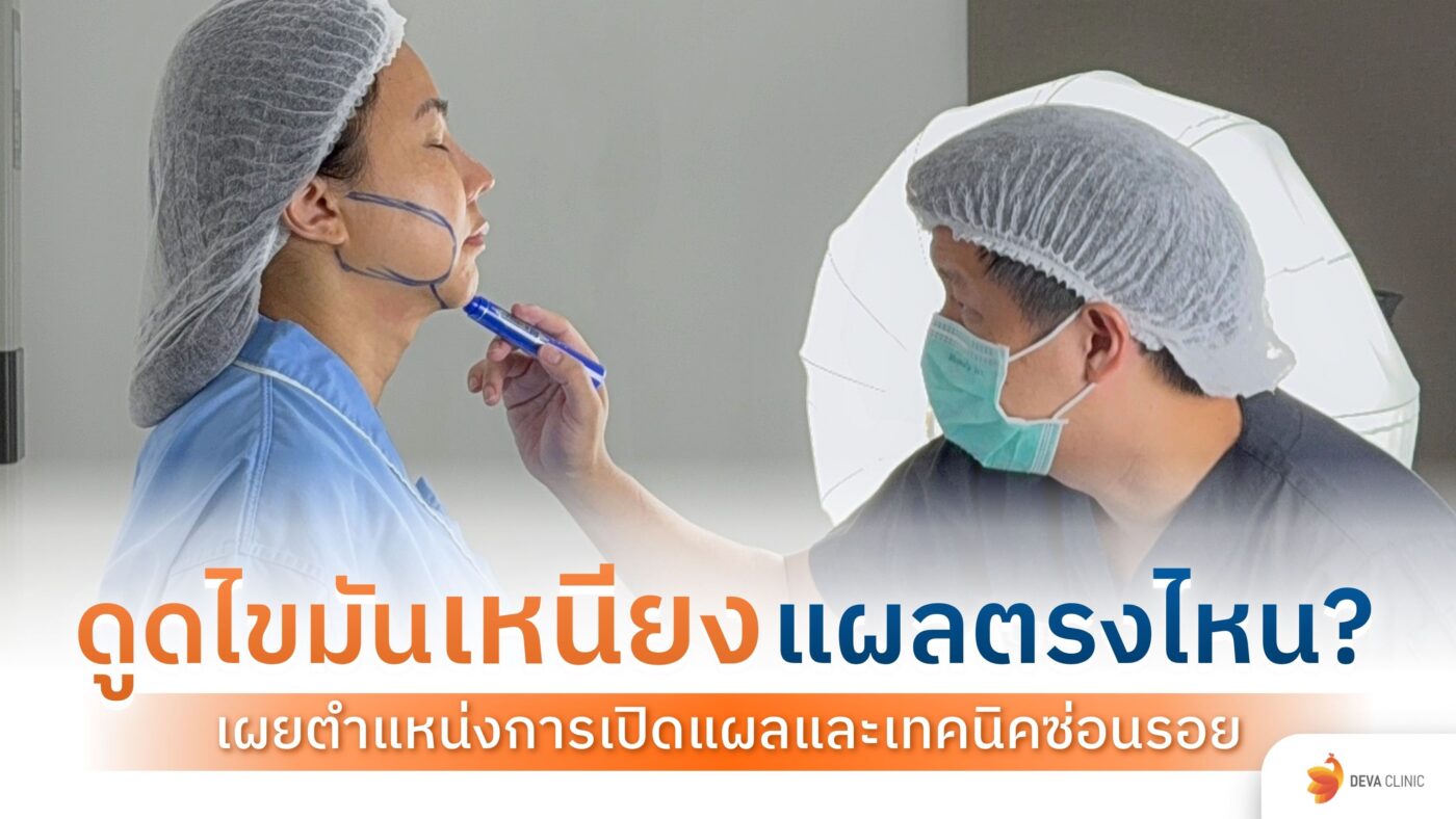 ดูดไขมันเหนียง แผลตรงไหน