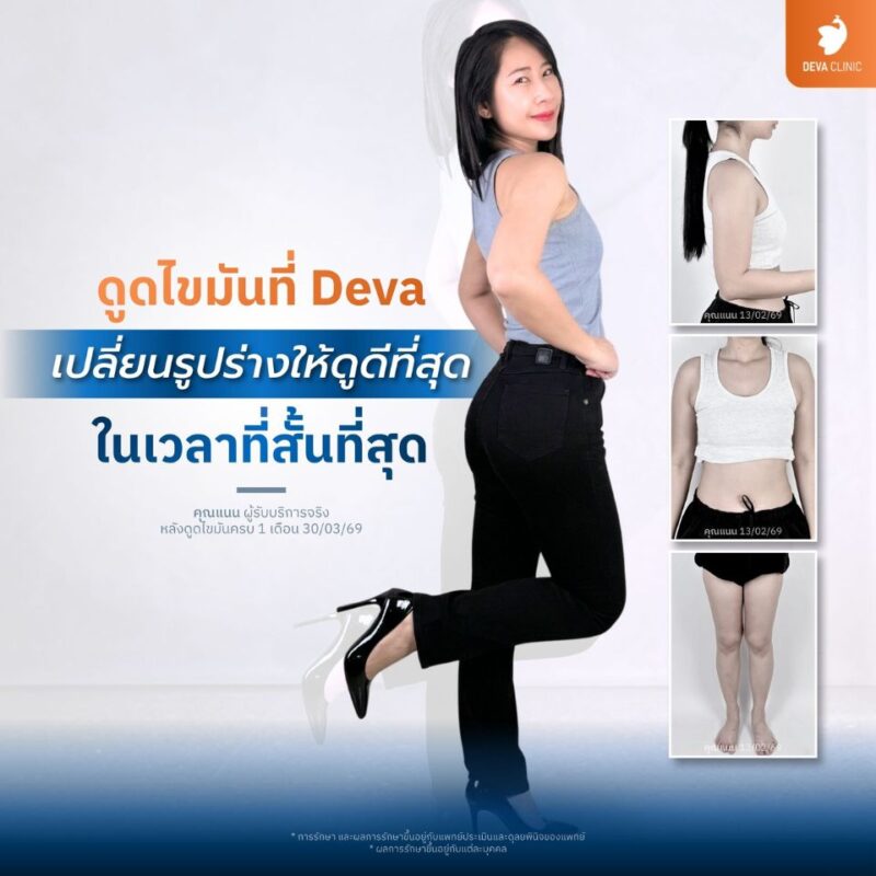 เทคนิคการเลือกดูดไขมันแบบเน้น “คุณภาพ” สวยเป๊ะ ไม่ต้องตามแก้