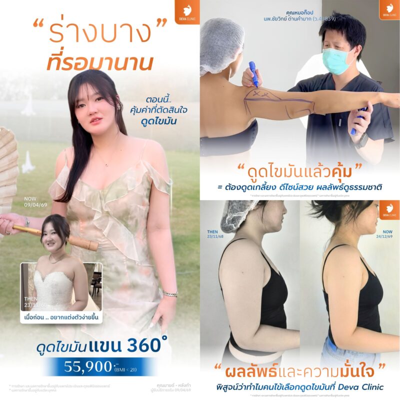 มีงบ 50,000 - 60,000 บาท ดูดไขมันตรงไหนให้คุ้มและเห็นผลชัดเจน?