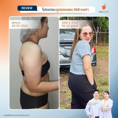 รีวิวดูดไขมันต้นแขน 10