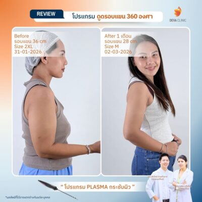 รีวิวดูดแขน ดูดไขมัน เกษตรนวมินทร์ 7