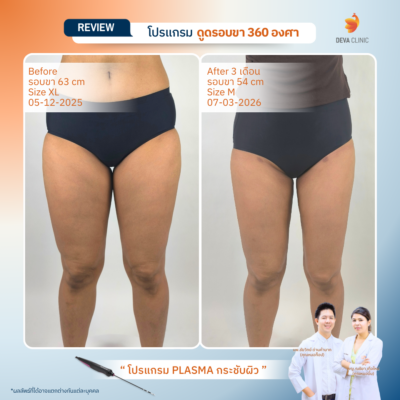 รีวิวดูดขา ดูดไขมัน เกษตรนวมินทร์ 9