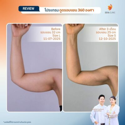 รีวิวต้นแขน - ดูดไขมัน วังหิน 11