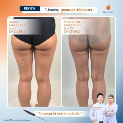 Deva Clinic รีวิวต้นขา 13
