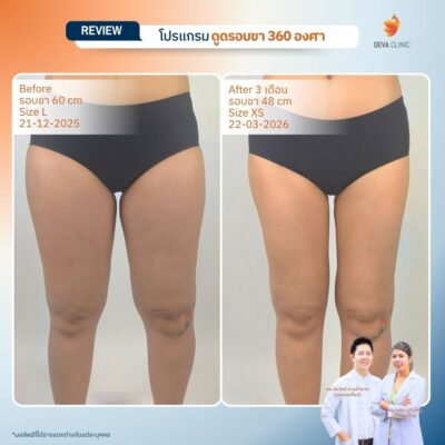 รีวิวต้นขา - ดูดไขมัน วังหิน 7