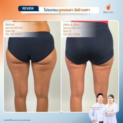 Deva Clinic รีวิวต้นขา 14
