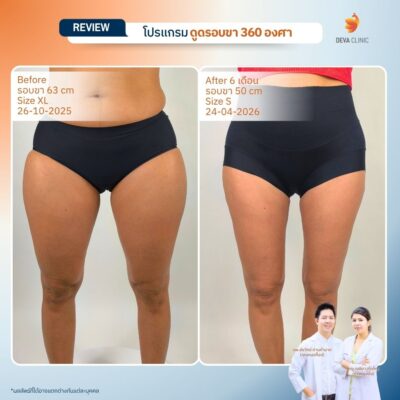 รีวิวดูดต้นขา ดูดไขมัน ลาดพร้าว 71 12