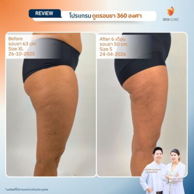 Deva Clinic รีวิวต้นขา 15