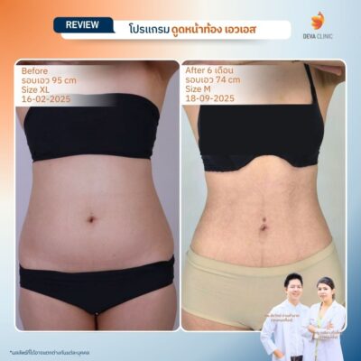 รีวิวดูดไขมันหน้าท้อง 3