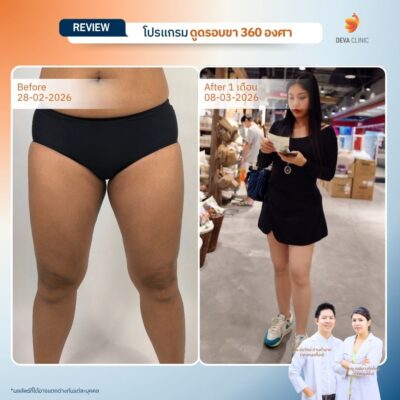 Deva Clinic รีวิวต้นขา 17