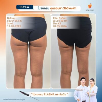Deva Clinic รีวิวต้นขา 16