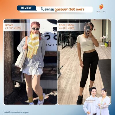 รีวิวดูดไขมันต้นขา 14