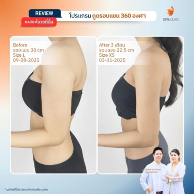 รีวิวต้นแขน - ดูดไขมัน วังหิน 9