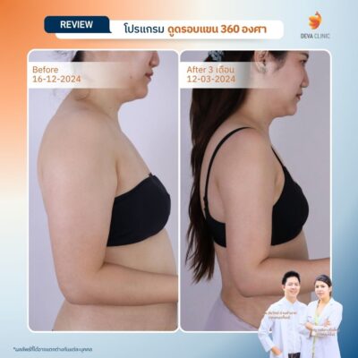 รีวิวดูดต้นแขน ดูดไขมัน ลาดพร้าว 71 18